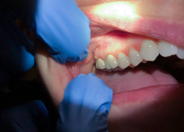 Best Emergency Tooth Extraction in Ivanhoe, TX