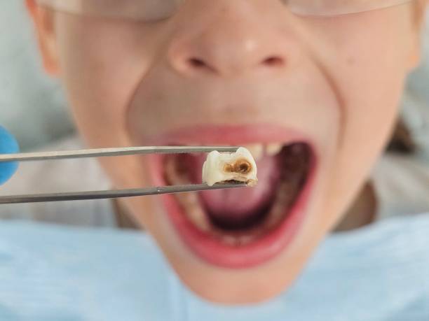 Best Emergency Gum Treatment in Ivanhoe, TX